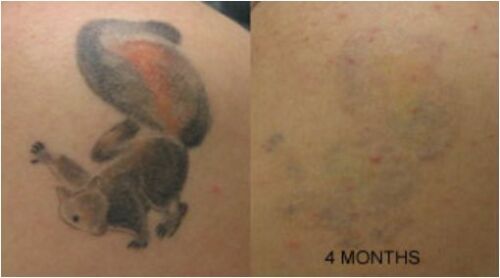 Tattoo Destroyer - Tattoo Removal Cream-1