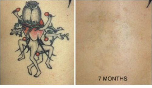 Tattoo Destroyer - Tattoo Removal Cream-3