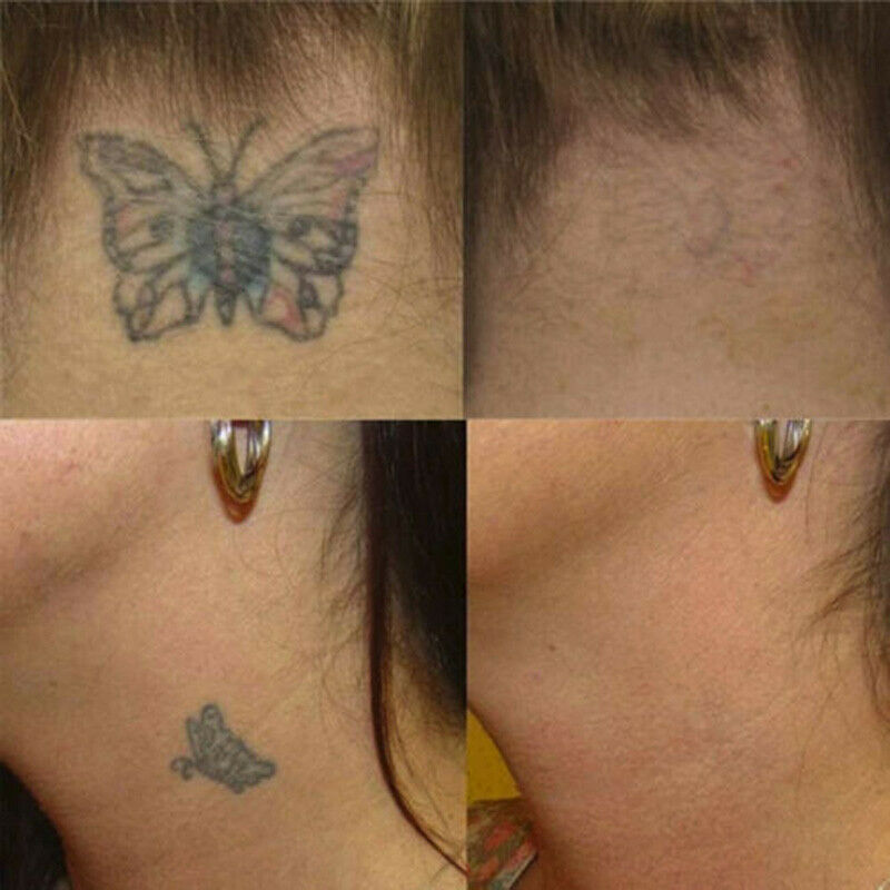 Tattoo Destroyer - Tattoo Removal Cream-4